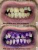 Zubní plak - zubní povlak