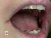 Bolavé ústní koutky