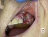 Nádory ústní dutiny